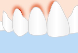 Schematische Darstellung einer Zahnfleischentzündung (Gingivitis)
